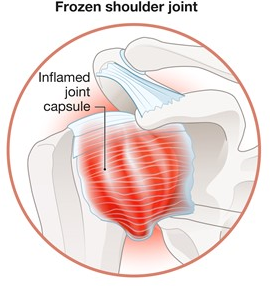 BLOGPOST_FrozenShoulderTreatment06222023B.png