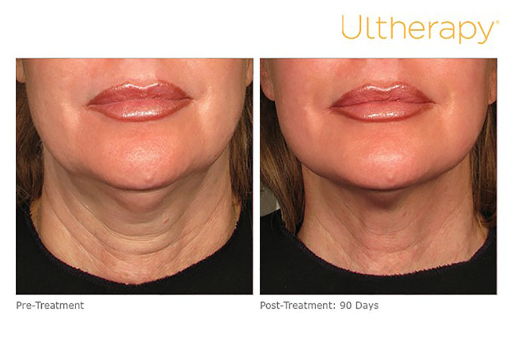 BLOGPOST_RefreshWithUltherapy10092025_s.png