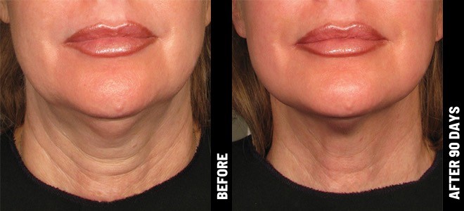 BLOGPOST_UltherapyFaceLift07202023A.jpg