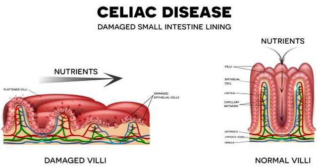 CeliacDisease_Example_A.jpg