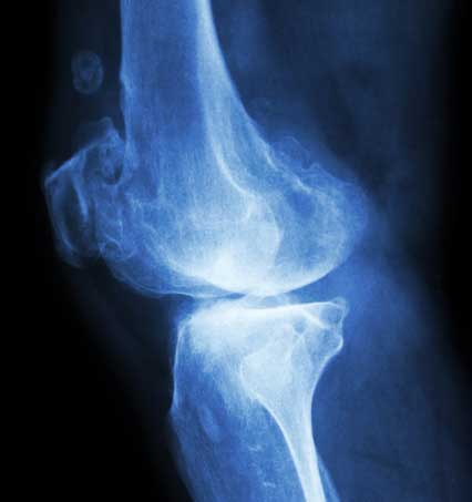 Regenrative_knee_xray_bone_on_bone.jpg